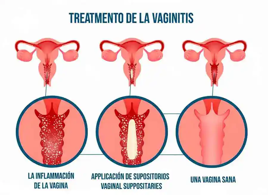 Vaginitis